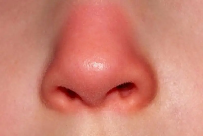 Mũi sưng đỏ sau uống bia rượu cần tái khám ngay