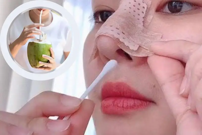 Sau nâng mũi không nên uống nước dừa trong khoảng 1 tuần