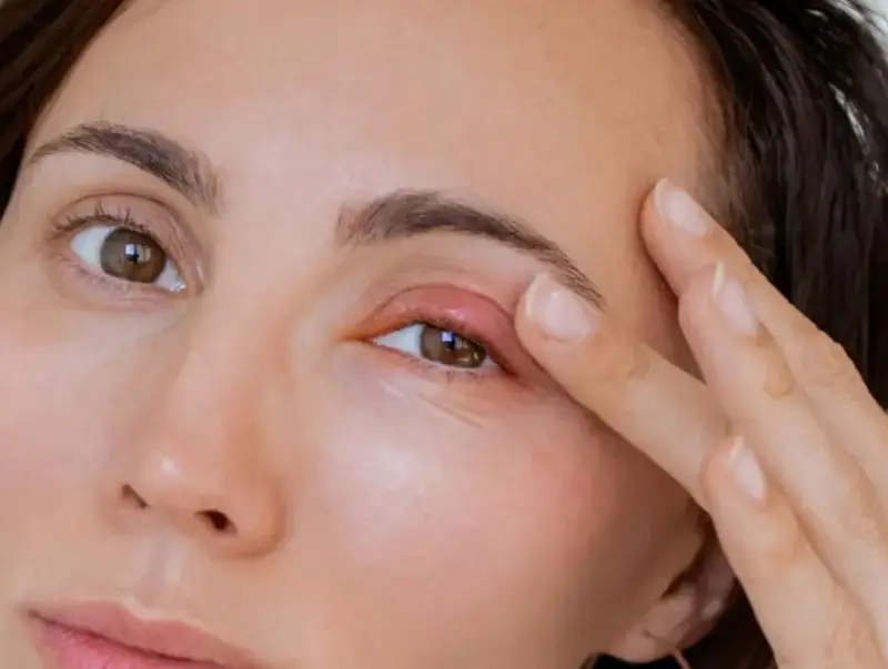 Mí mắt sau nhấn bị nổi cục, sưng tấy lâu dài