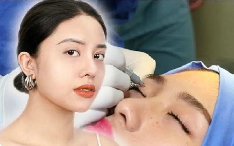 Nhấn mí là tiểu phẫu dễ thực hiện, không can thiệp xâm lấn