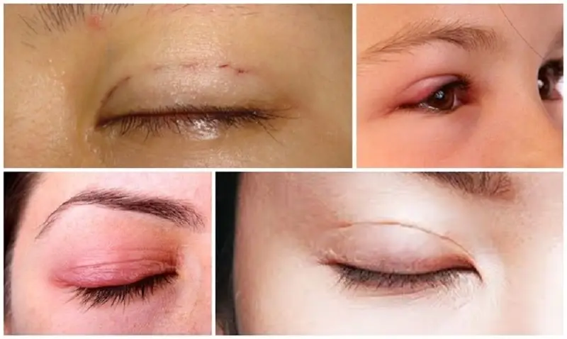 Nếp mí mắt không đều hoặc thiếu cân đối