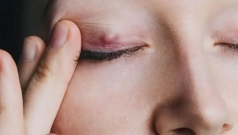 Mí mắt có thể bị nổi cục, nhiễm trùng nếu thực hiện nhấn mí không đúng kỹ thuật