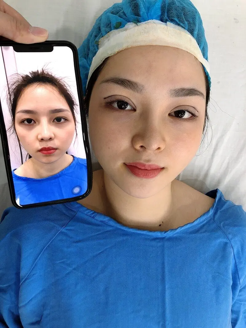 Nhấn mí bằng kỹ thuật hiện đại sẽ tạo nếp mí tự nhiên, cân đối