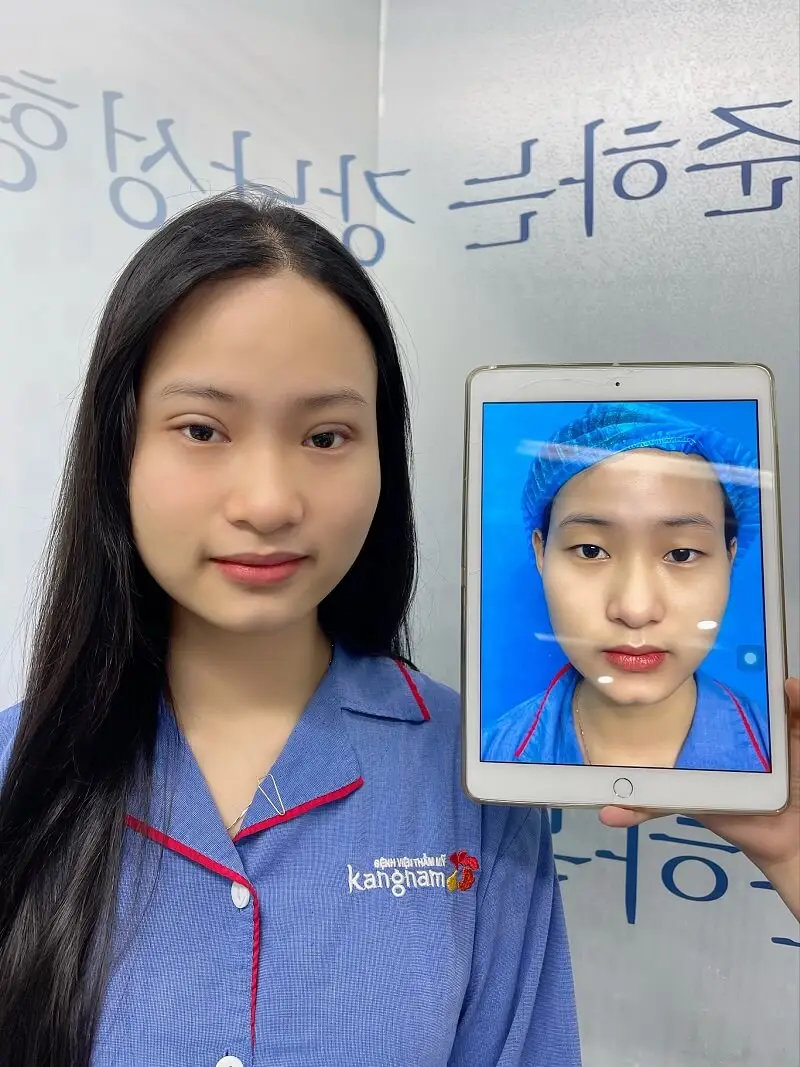 Nhấn mí được thực hiện đúng kỹ thuật sẽ không gây nguy hiểm