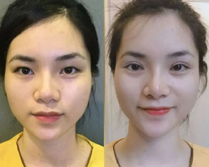 Nhấn mí không mang lại hiệu quả được vĩnh viễn