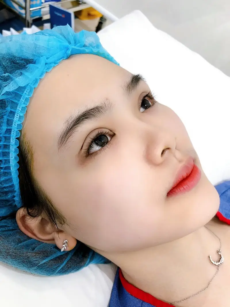 Sau nhấn mí khách hàng cảm thấy hơi căng tức và sưng ở mí mắt