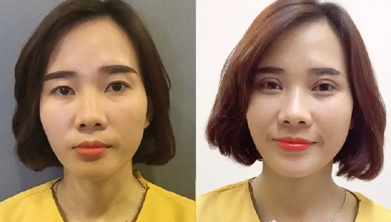 Phương pháp nhấn mini tạo nếp mí đẹp tự nhiên