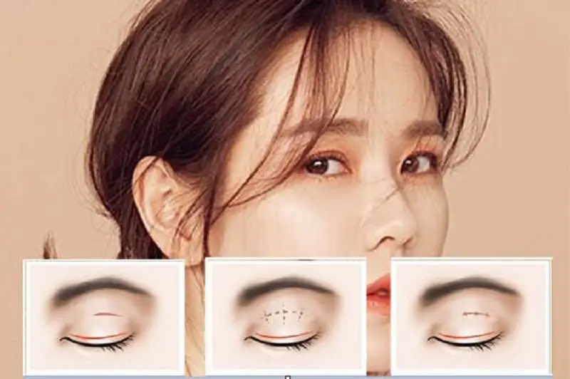 Nhấn mí nano 2 lớp không mang lại hiệu quả vĩnh viễn