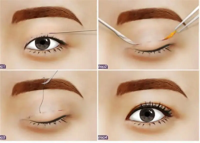 Có thể nhấn mí thêm lần thứ hai