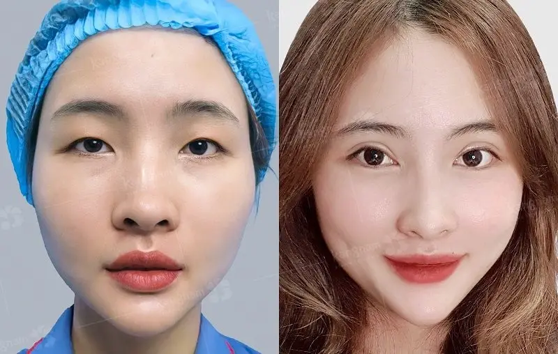 Cắt mí có thể giúp khắc phục mọi khuyết điểm ở vùng mí mắt