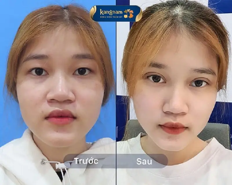 Kangnam thực hiện bấm mí Hàn Quốc Đa điểm