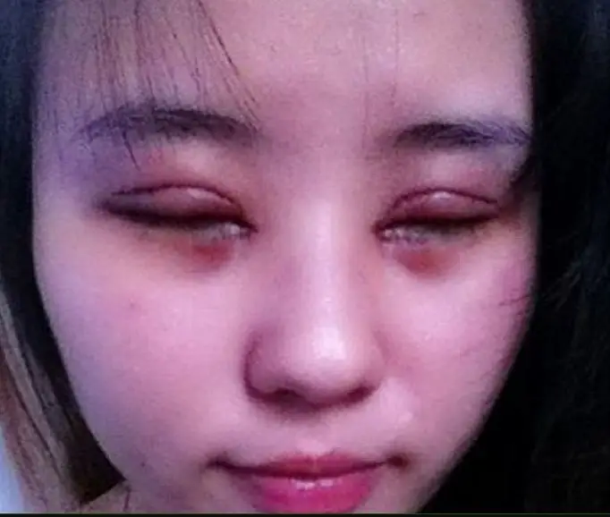 Mí mắt bị bầm tím sau khi nhấn mí