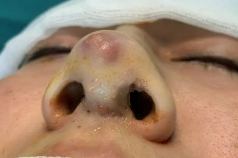 Thủng da đầu mũi