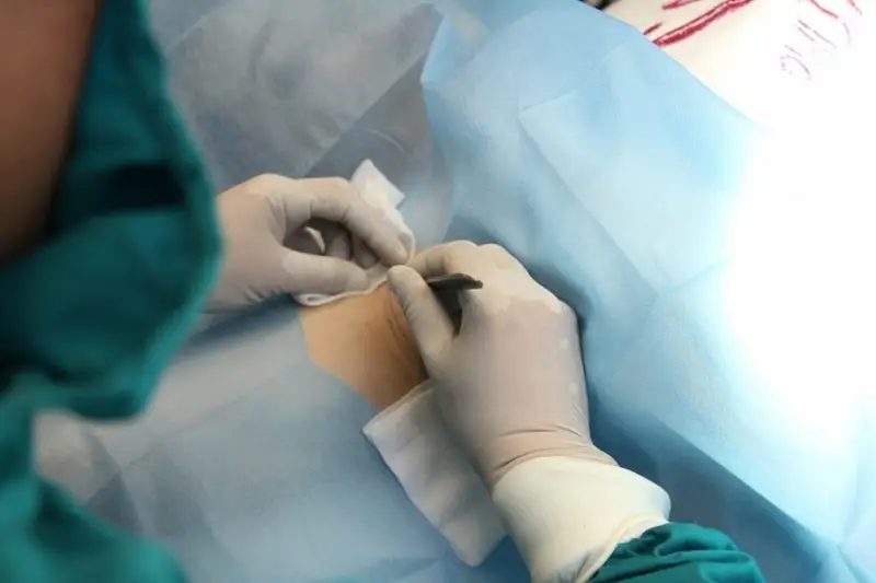 Phẫu thuật cắt tuyến mồ hôi sẽ mang lại kết quả tối ưu