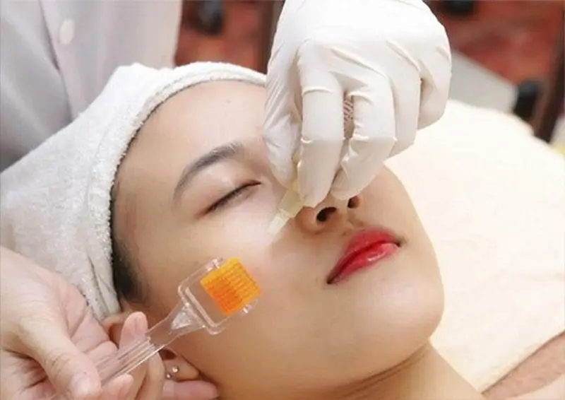 Bác sĩ dùng những đầu kim nhỏ tác động lên bề mặt da bị sẹo