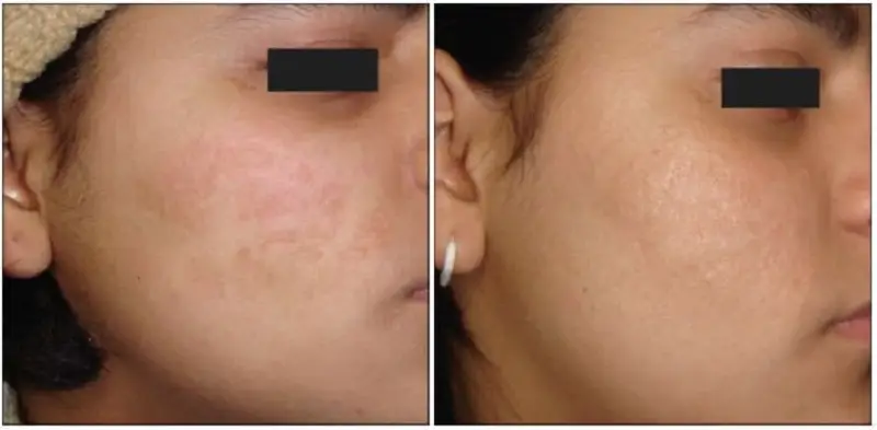 Làn da được cải thiện sau trị sẹo lõm bằng lăn kim