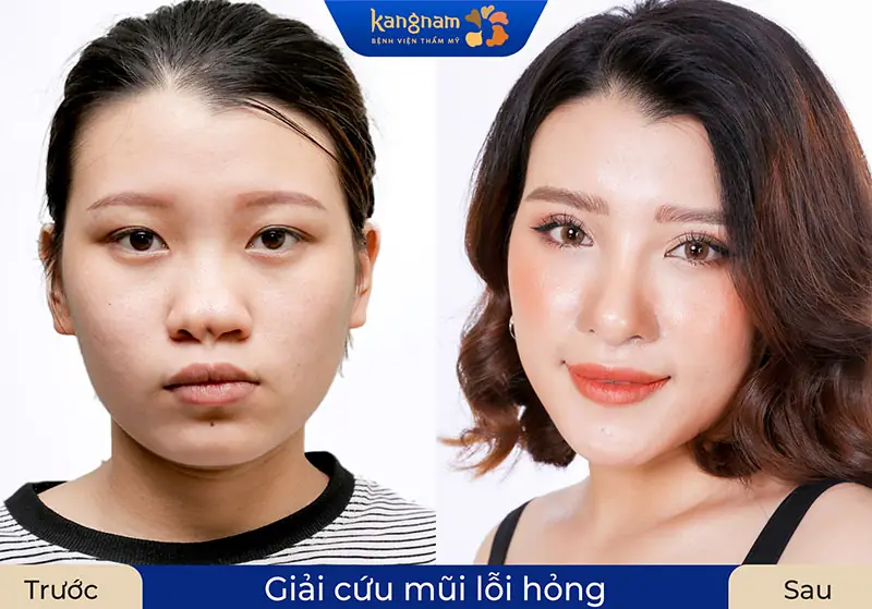 Dáng mũi ổn định, tự nhiên sau chỉnh sửa mũi hỏng tại Kangnam