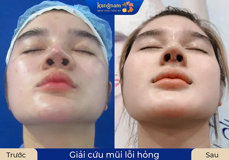 Trường hợp khách hàng từng nâng mũi hỏng, hiện đã được chỉnh sửa thành công với dáng mũi hài hòa, tự nhiên