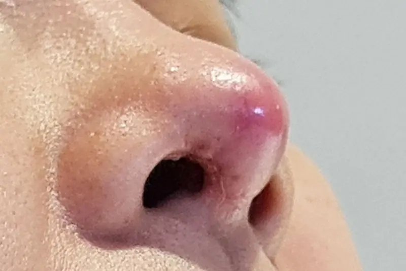 Sưng đỏ lâu ngày ở vùng mũi là dấu hiệu cảnh báo phản ứng đào thải