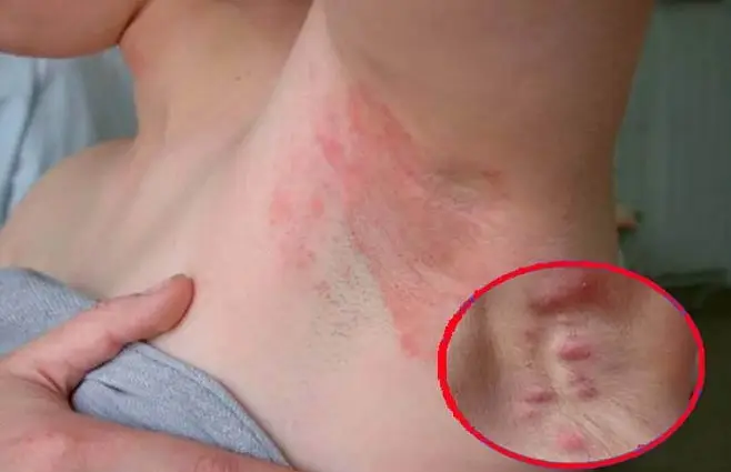 Vùng nách có thể gây kích ứng sau khi dùng phèn chua trị mùi hôi