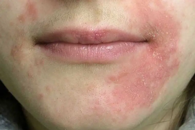 Triệt lông mặt sai cách có thể gây bỏng nhiệt, thay đổi sắc tố