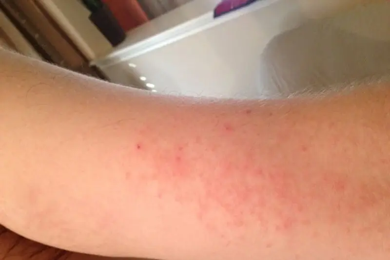 Triệt lông bằng laser sai kỹ thuật gây kích ứng da