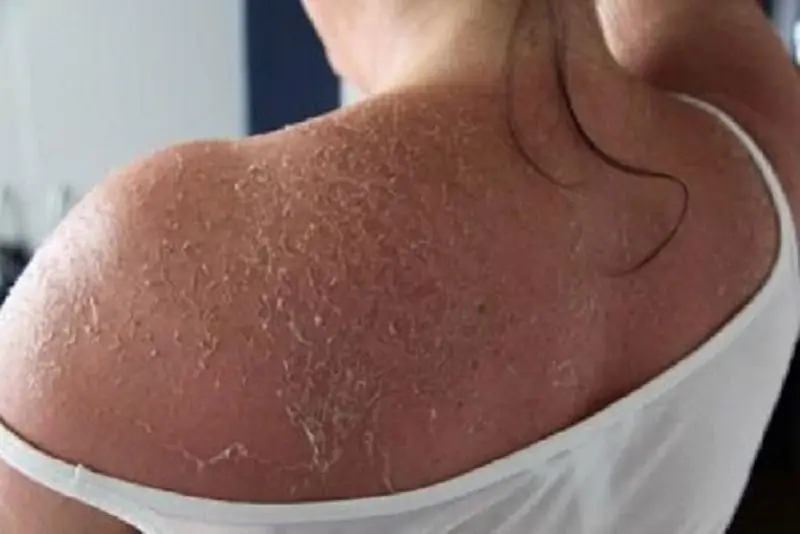 Da bị bong tróc do sử dụng chất tẩy trắng mạnh