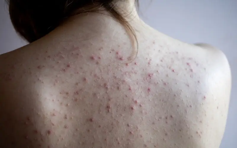 Da bị viêm đỏ, kích ứng, nổi mụn