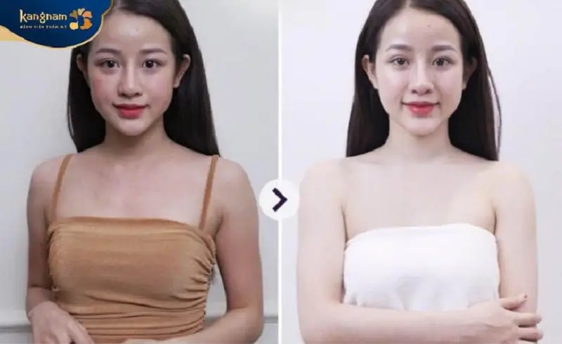 Chị em sở hữu làn da tươi sáng, mịn màng sau khi tắm trắng tại Kangnam