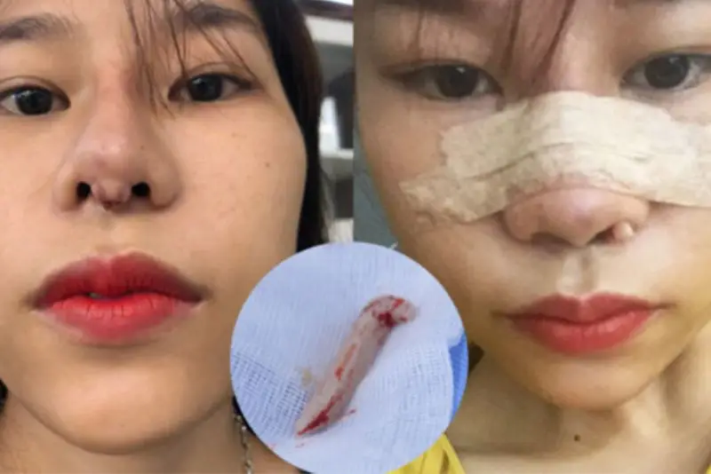 Dáng mũi bị biến dạng do bao xơ quanh sụn gây co rút mô mềm.