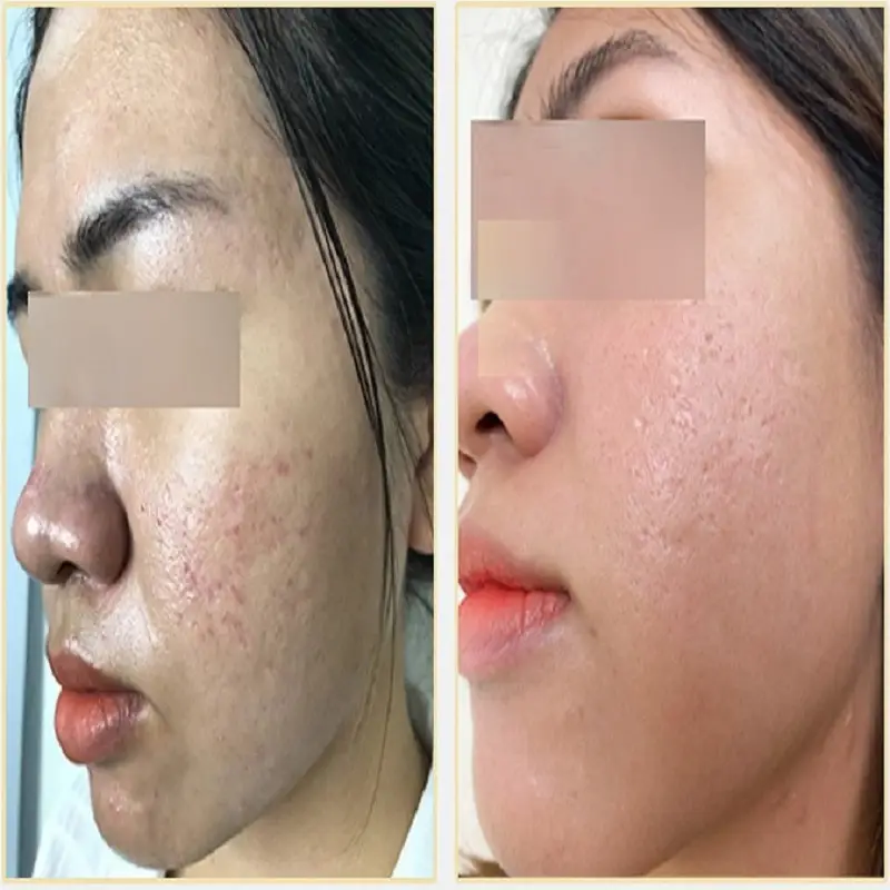 Vùng da bị sẹo lõm được cải thiện sau khi tiêm collagen