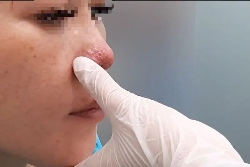 Mũi chảy dịch nhầy, filler tràn xuống cánh mũi và khiến vùng mũi phồng bất thường