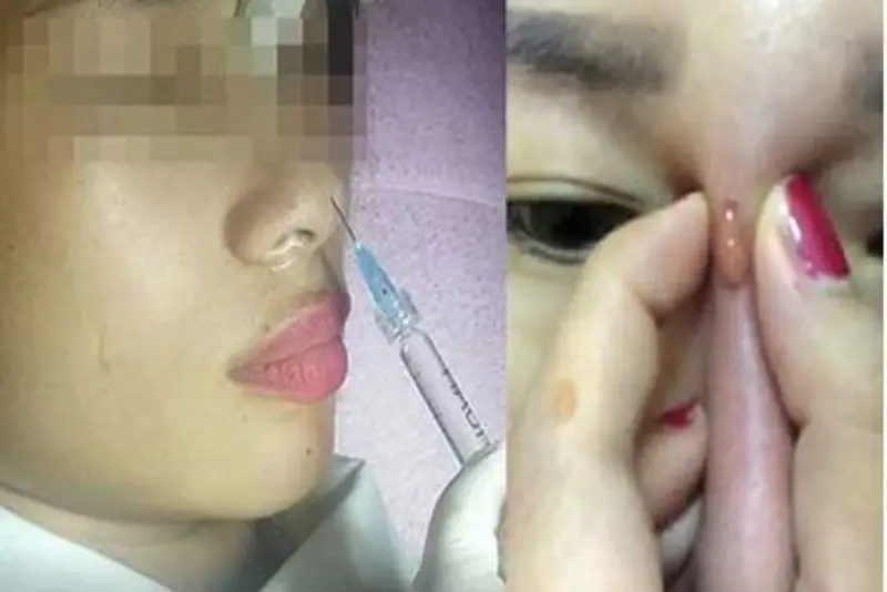 bác sĩ có thể chỉ định tiêm enzyme hyaluronidase