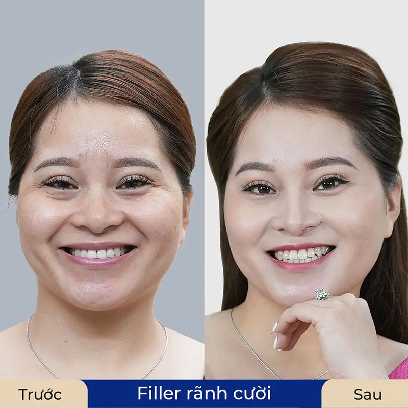 Khách hàng tiêm filler rãnh cười tại Kangnam trẻ ra đến 5 tuổi