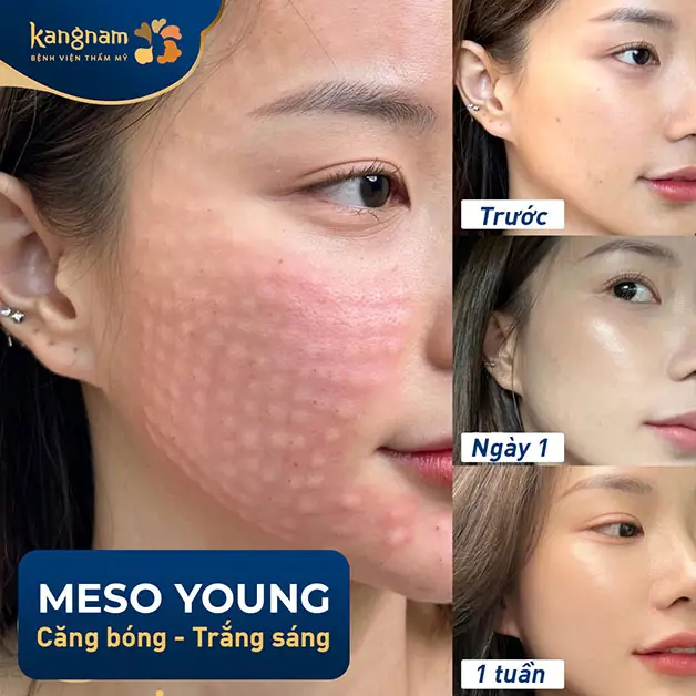 Tiêm meso young tại Kangnam Đà Nẵng