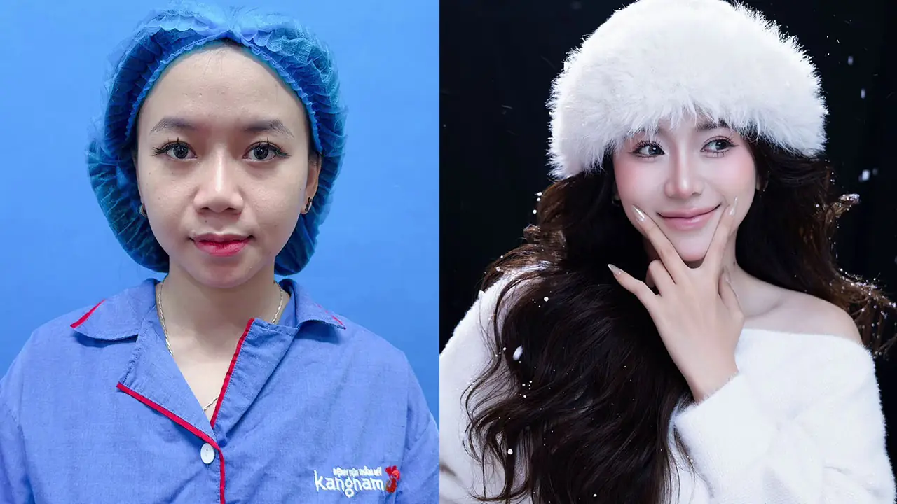 Hình ảnh chụp chính diện trước và sau nâng mũi cấu trúc