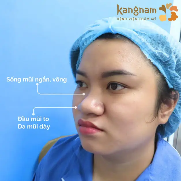 Dáng mũi nhiều khuyết điểm không phù hợp nâng mũi bằng chỉ