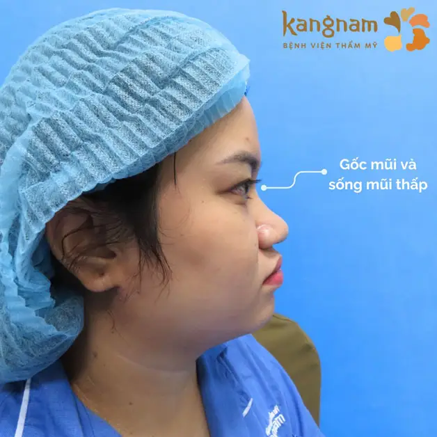 Trường hợp mũi ngắn, tẹt, đầu mũi to, không phù hợp nâng mũi thường