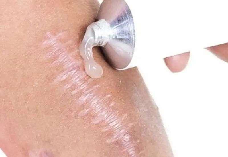 Sử dụng các loại kem bôi có chiết xuất từ nha đam