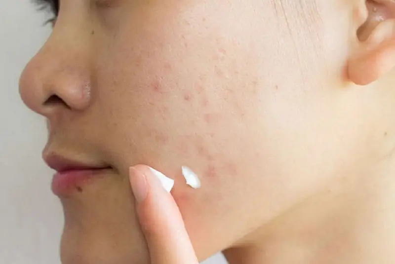 Các loại kem bôi có khả năng làm mờ sẹo lồi do mụn