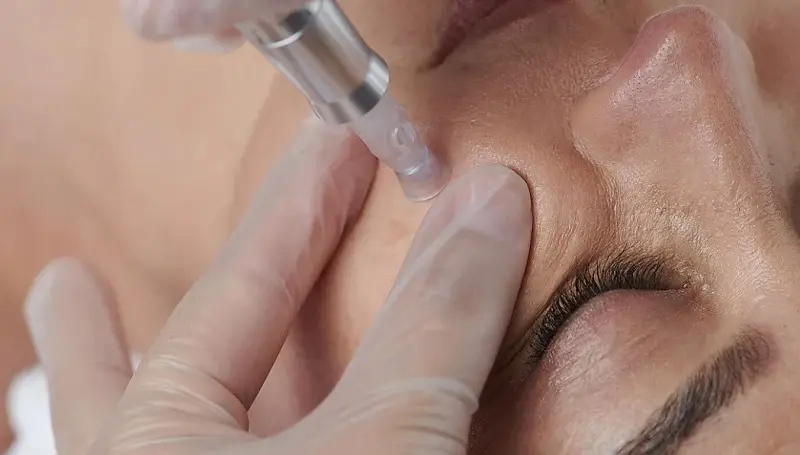 Micro-needling cũng là cách trị sẹo mụn lồi hiệu quả cao