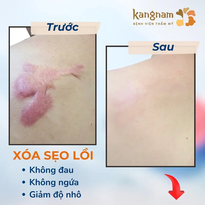 Vết sẹo được làm mờ hiệu quả không gây đau, không ngứa