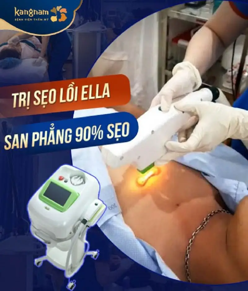 Trị sẹo lồi lâu năm tại Kangnam ứng dụng công nghệ ELLA