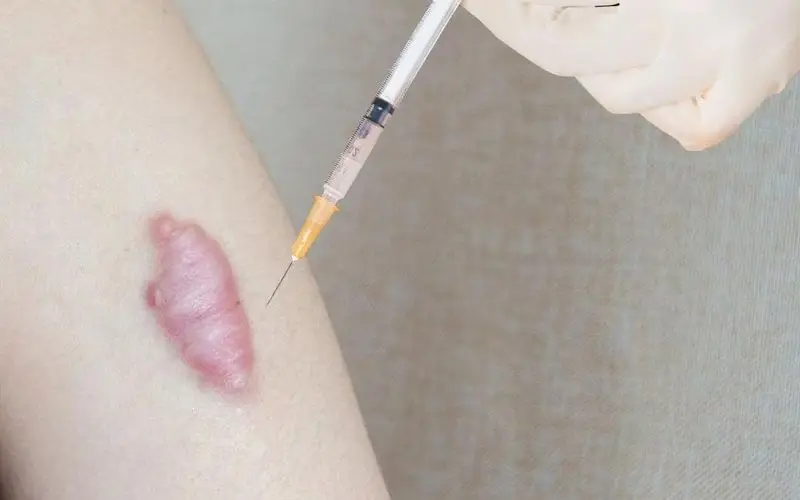Tiêm trị sẹo lồi phù hợp với những vết sẹo nhỏ