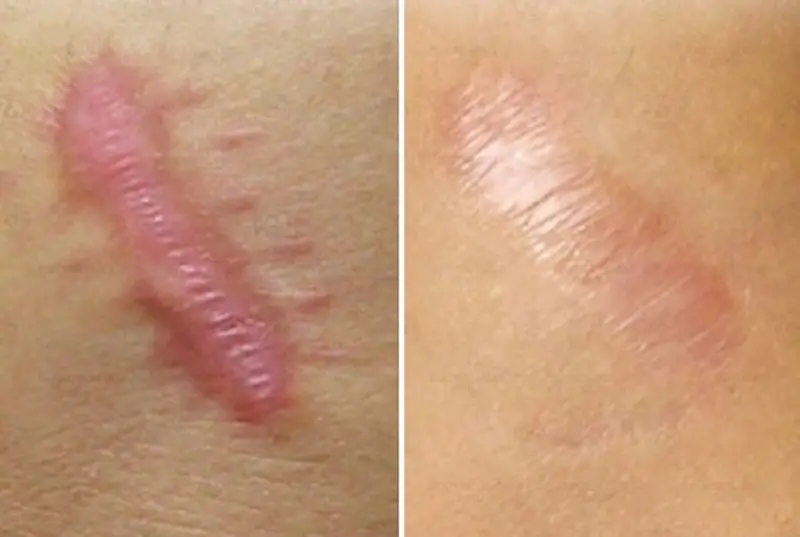 Phương pháp áp lạnh giúp đóng băng vết sẹo lồi
