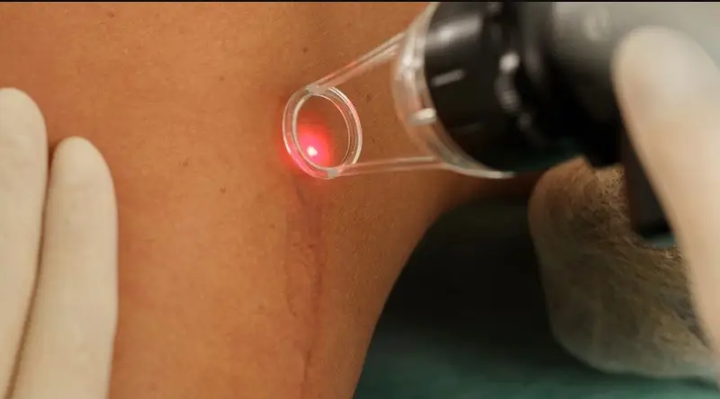 Công nghệ laser giúp làm mờ vết sẹo hiệu quả
