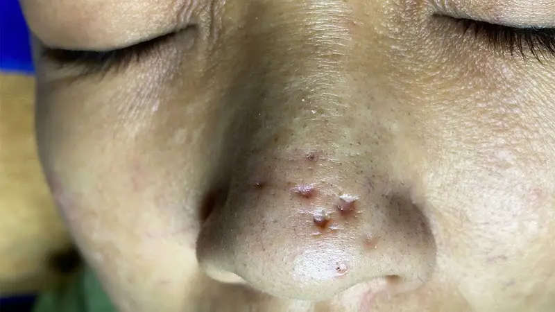 Phương pháp bóc tách đáy sẹo sẽ giúp kích thích sản sinh collagen