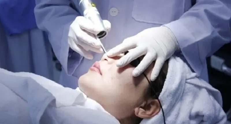 Phương pháp laser được ứng dụng để trị sẹo lõm ở mũi