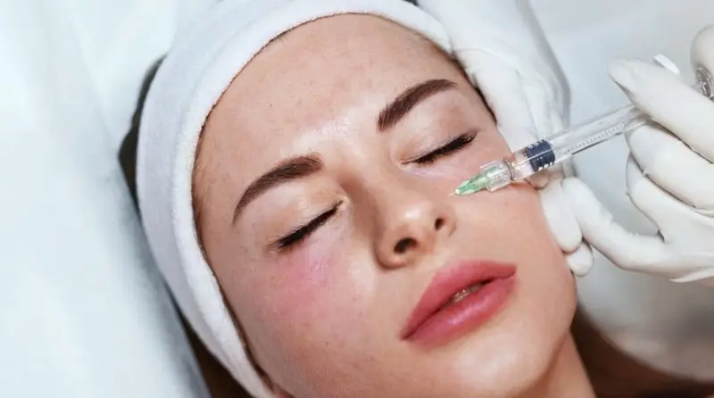 Tiêm meso giúp làm đầy vùng mũi bị sẹo lõm