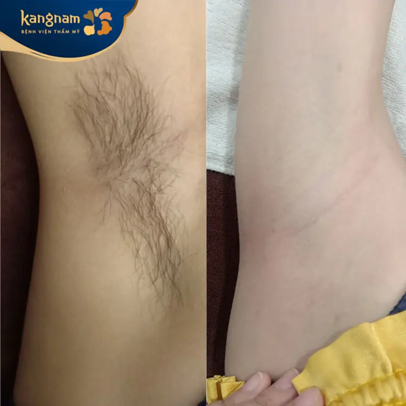 Triệt lông nách bằng laser nhanh gọn, không tốn thời gian